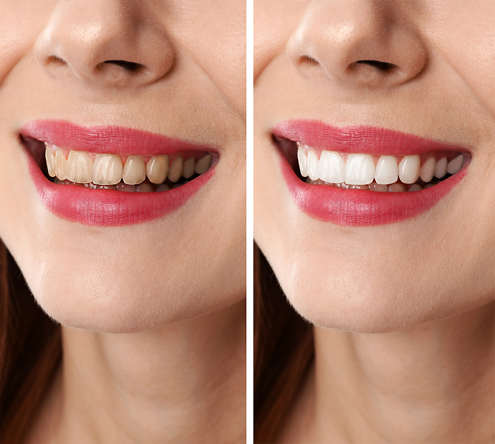 Faccette Dentali Ceramica 11