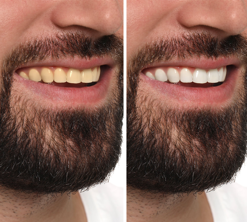 Faccette Dentali Ceramica 12