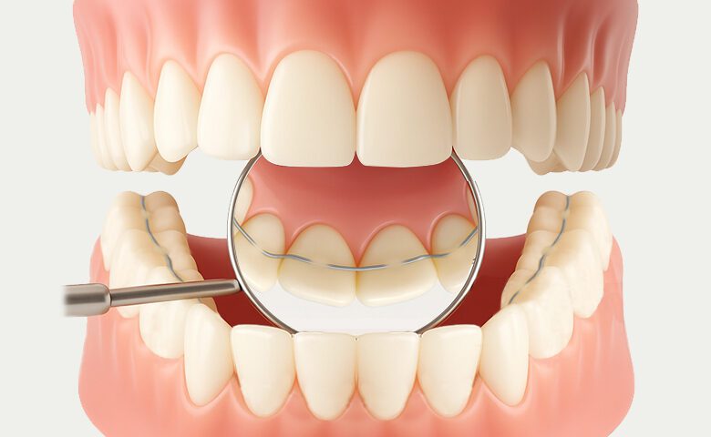 tecnica apparecchio denti filo invisibile